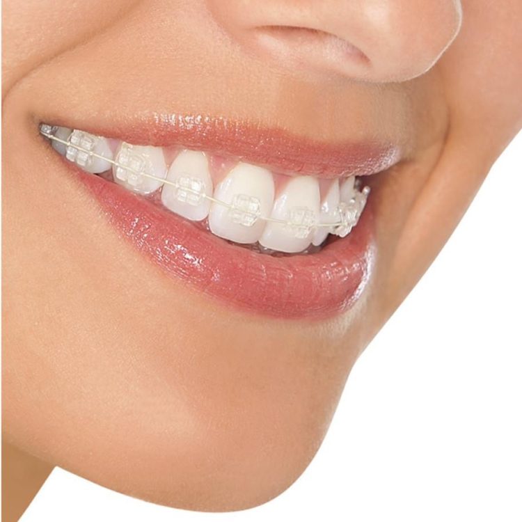 Consulta de Instalação do Aparelho Invisalign - VS Ortodontia