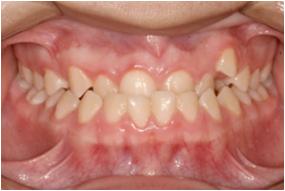 Tratamento Ortodôntico - Salvador Aparelho Ortodontia tratar Invisalign