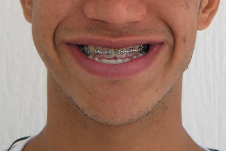 Deficiência maxilar e excesso mandibular (Classe III esquelética)