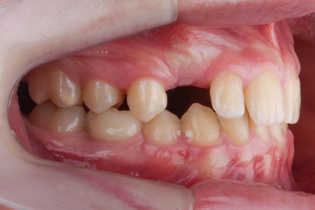 Tratamento Ortodôntico - Salvador Aparelho Ortodontia tratar Invisalign